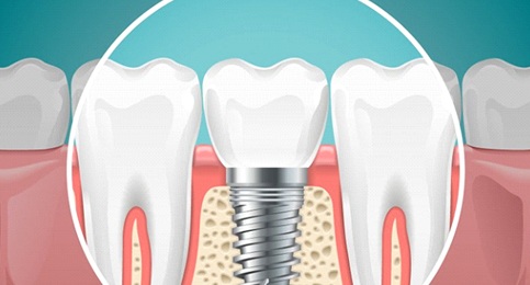dental implant post in the jawbone