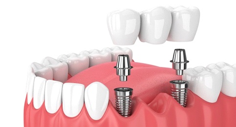 dental bridge supported by two dental implant posts 