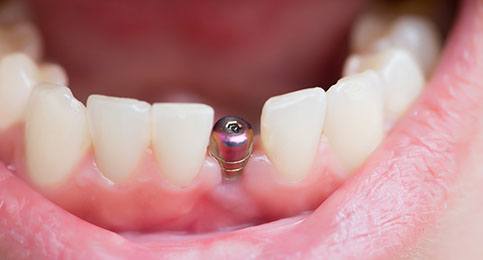 An up-close image of a dental implant post located on the lower arch between two healthy teeth
