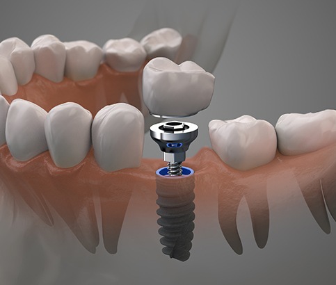 Animated smile during dental implant tooth replacement