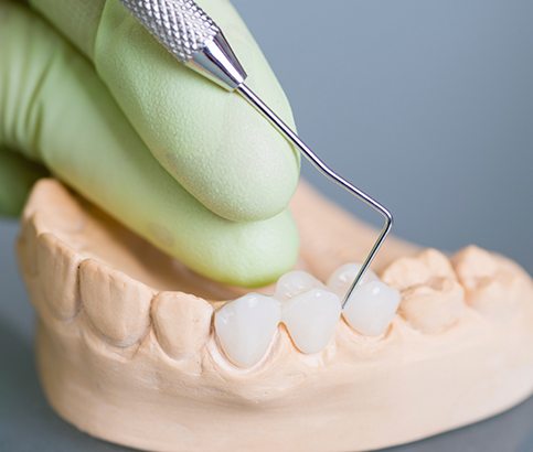 Model smile with dental bridge replacing missing teeth