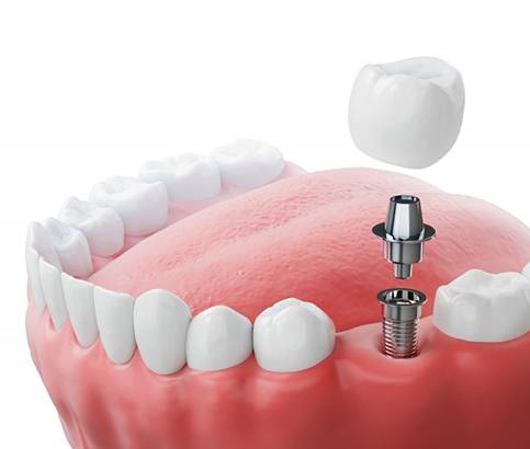 a 3 D example of a dental implant and abutment