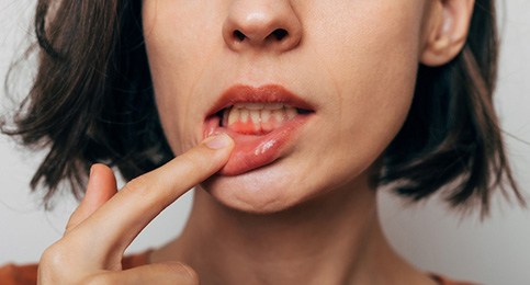 Woman with gum irritation