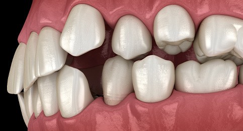 Illustration of gapped teeth