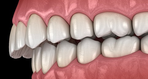 Illustration of an overbite