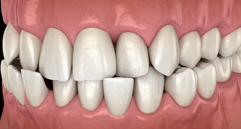 Illustration of a crossbite