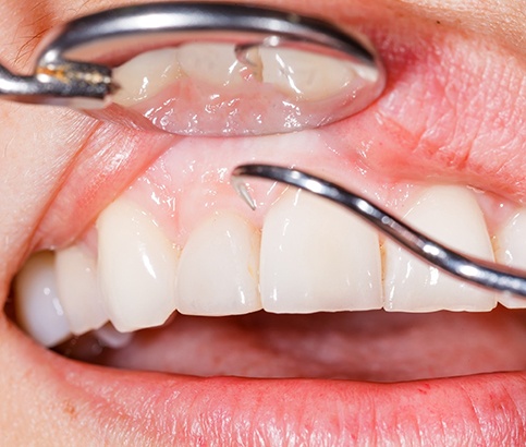 Close up of a dental checkup