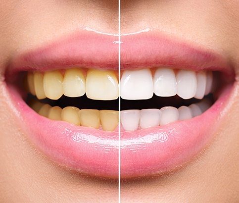 Smile before and after teeth whitening