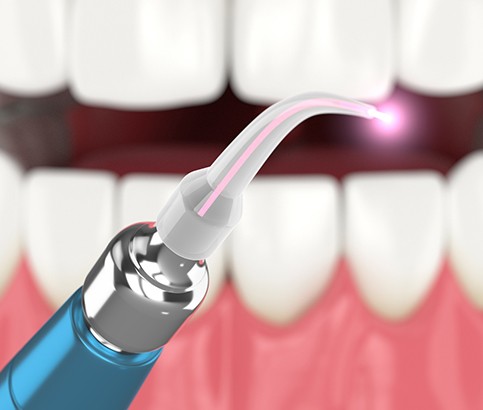 Illustration of dental laser