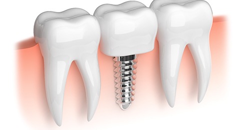 Single dental implant in Reno, NV between two natural teeth