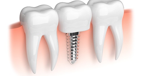 Single dental implant in Reno, NV between two natural teeth