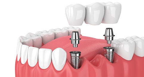 Two dental implants in Reno, NV for a dental bridge