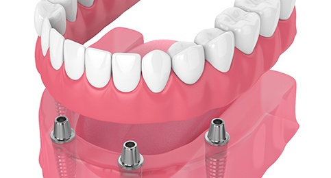 Illustration of dentures being placed on four dental implants in Reno, NV