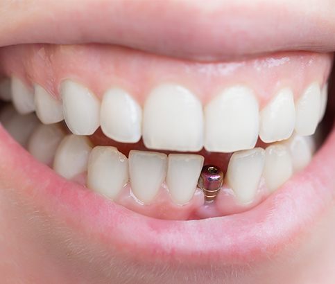 Smile with dental implant post visible