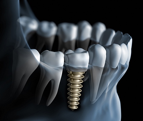 Animated dental implant supported dental crown