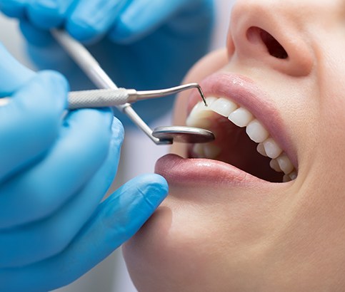 Patient receiving scaling and root planing periodontal therapy