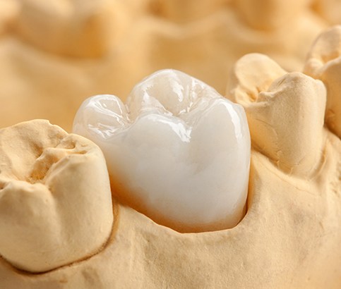 Model smile with dental crown restoration