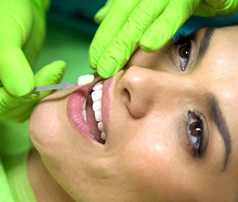 Woman having veneers in Reno placed