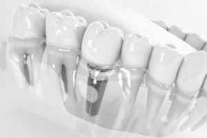 Greyscale rendering of dental implant in lower jaw