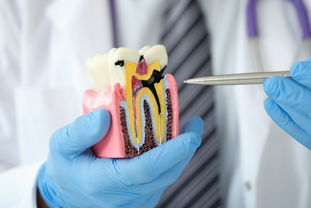 Dentist pointing to a hidden cavity in a model tooth
