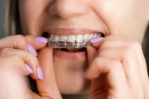 Close-up of woman putting in a clear aligner